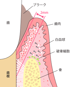 外苑前（港区北青山）の歯医者、サウラデンタルクリニックで歯周病治療